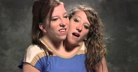 nude conjoined twins|Conjoined Twins nude Search